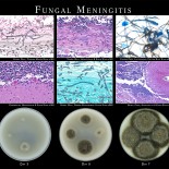 Fungal Meningitis